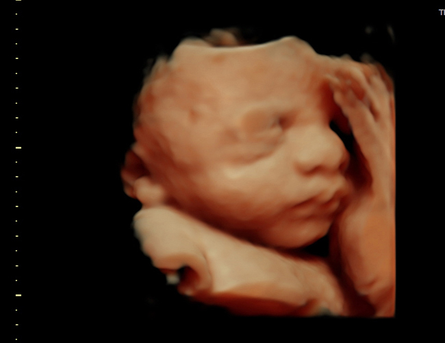 3D ultrasound image at 31 weeks